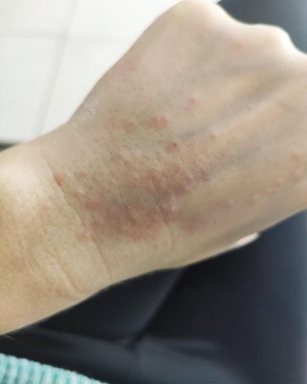 В Запорожской области женщина заработала дерматит после использования магазинного антисептика (ФОТО)